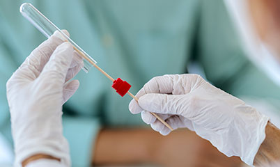 diagnosi alzheimer tampone