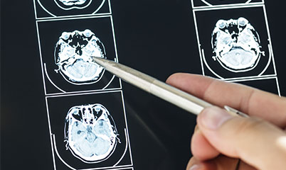 litio e alzheimer studio harvard medical school